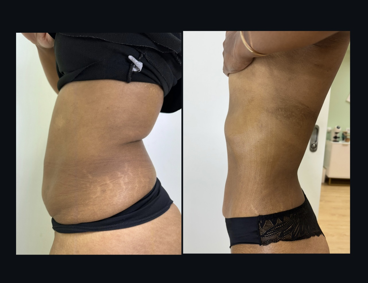 Resultado de crioescultura — antes e depois, vista lateral