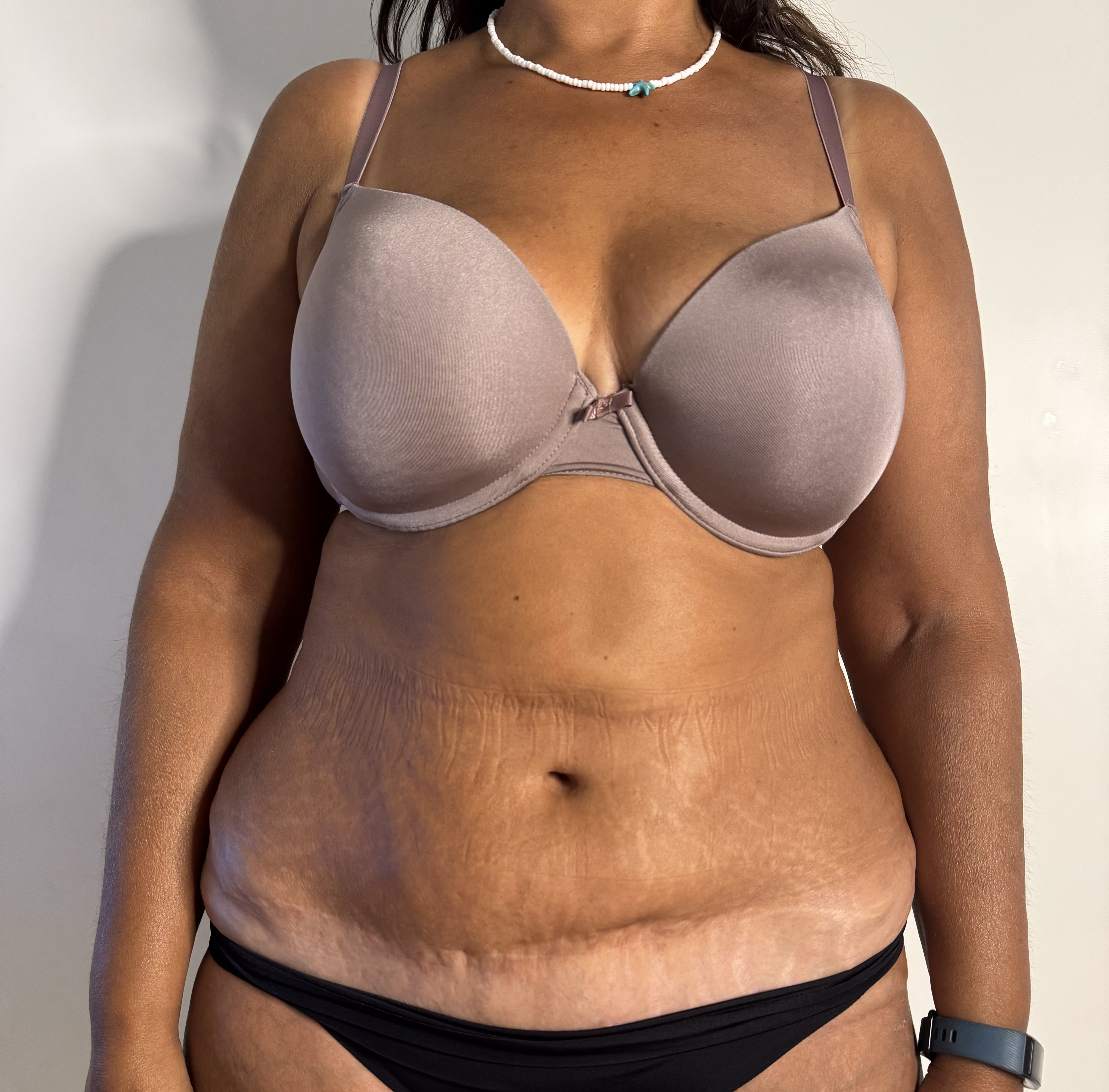 Antes do tratamento — vista frontal