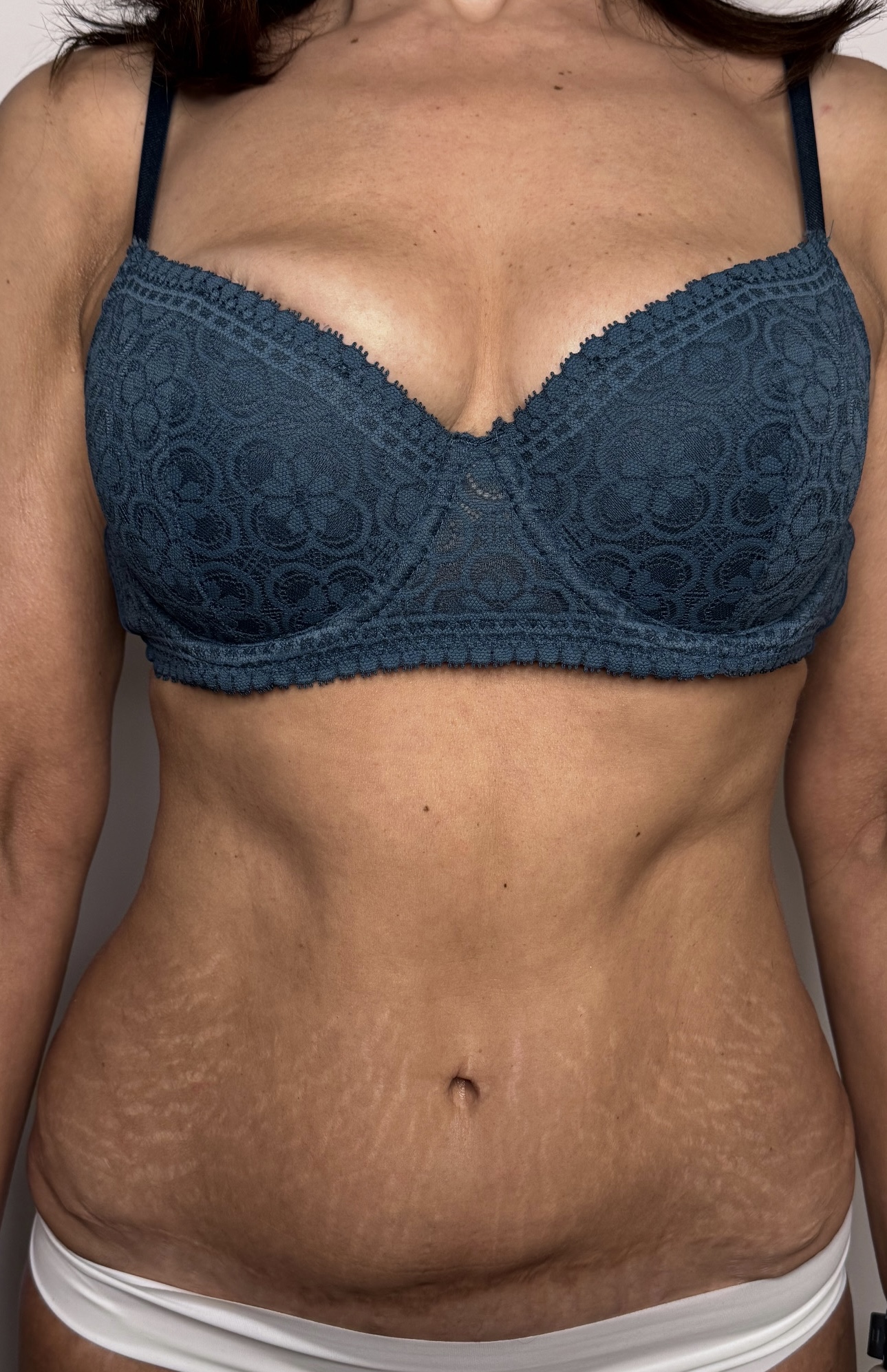 Depois do tratamento — vista costas